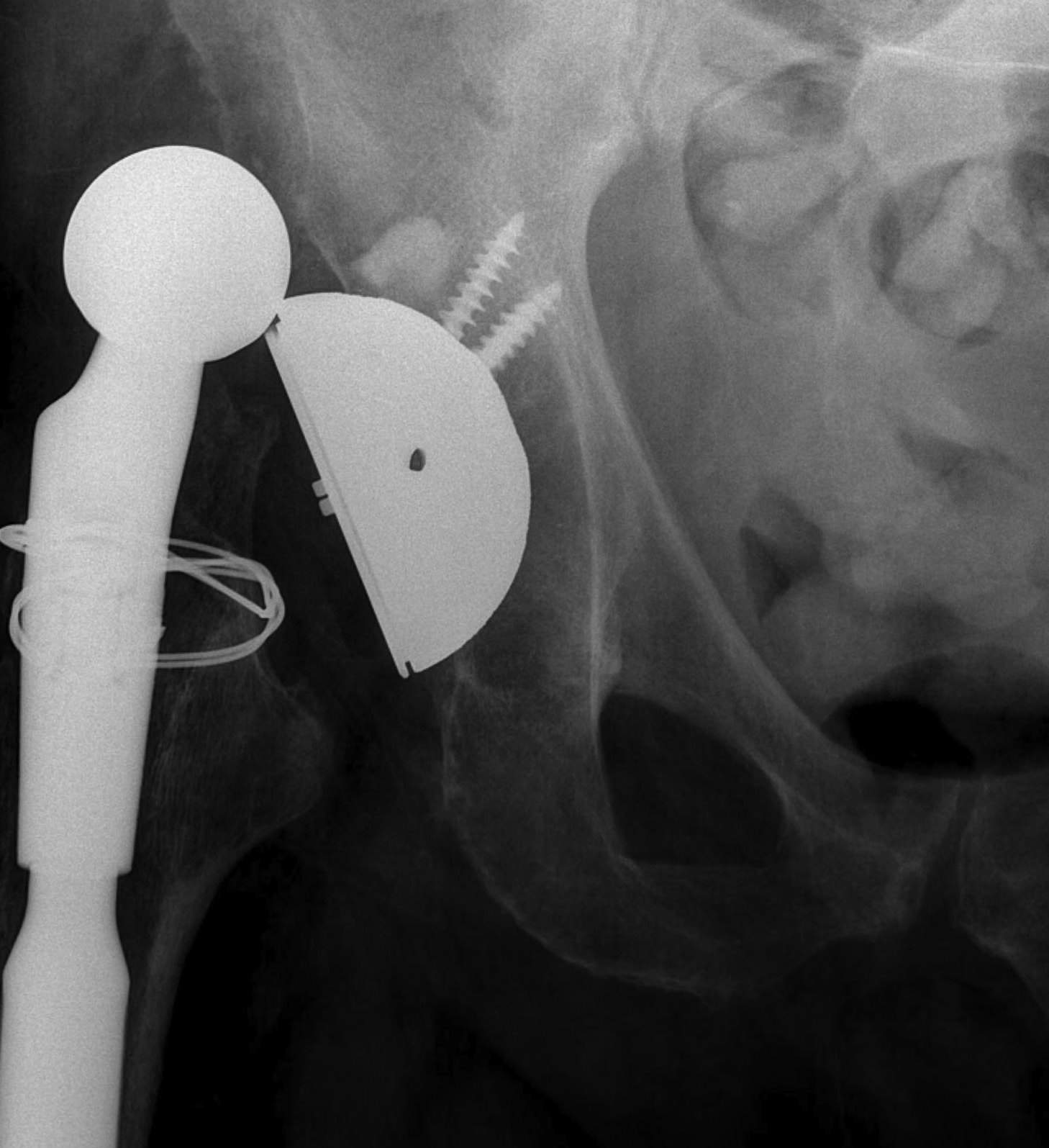 THR Dislocation Abducted Acetabular Component